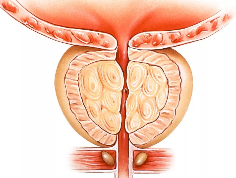 Prostatīts