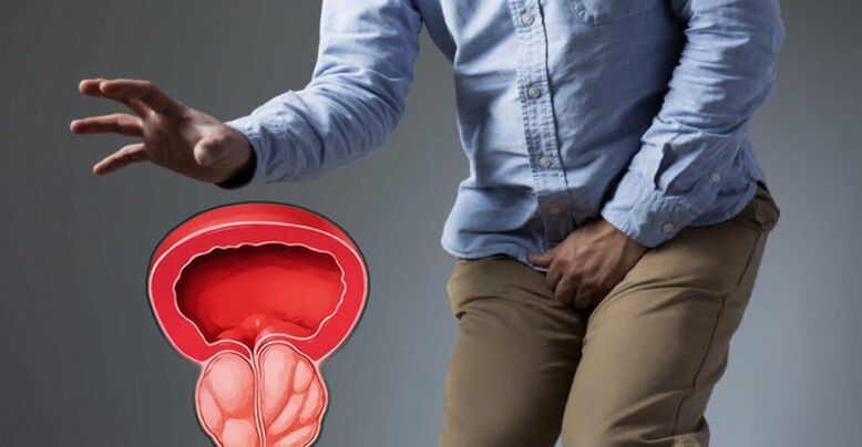 Prostatīta un prostatas adenomas profilakse